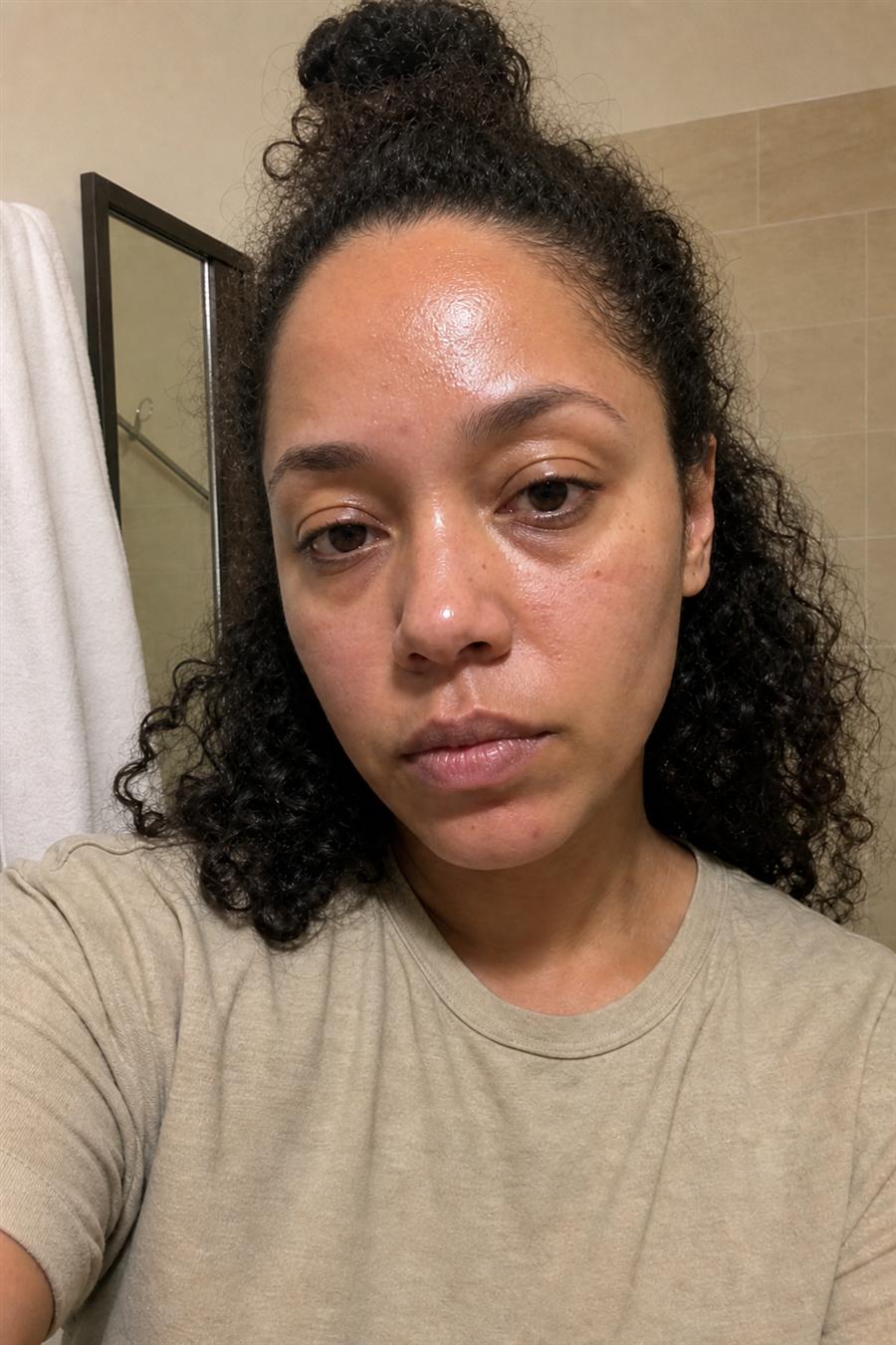Before using VYRELLE tallow cream